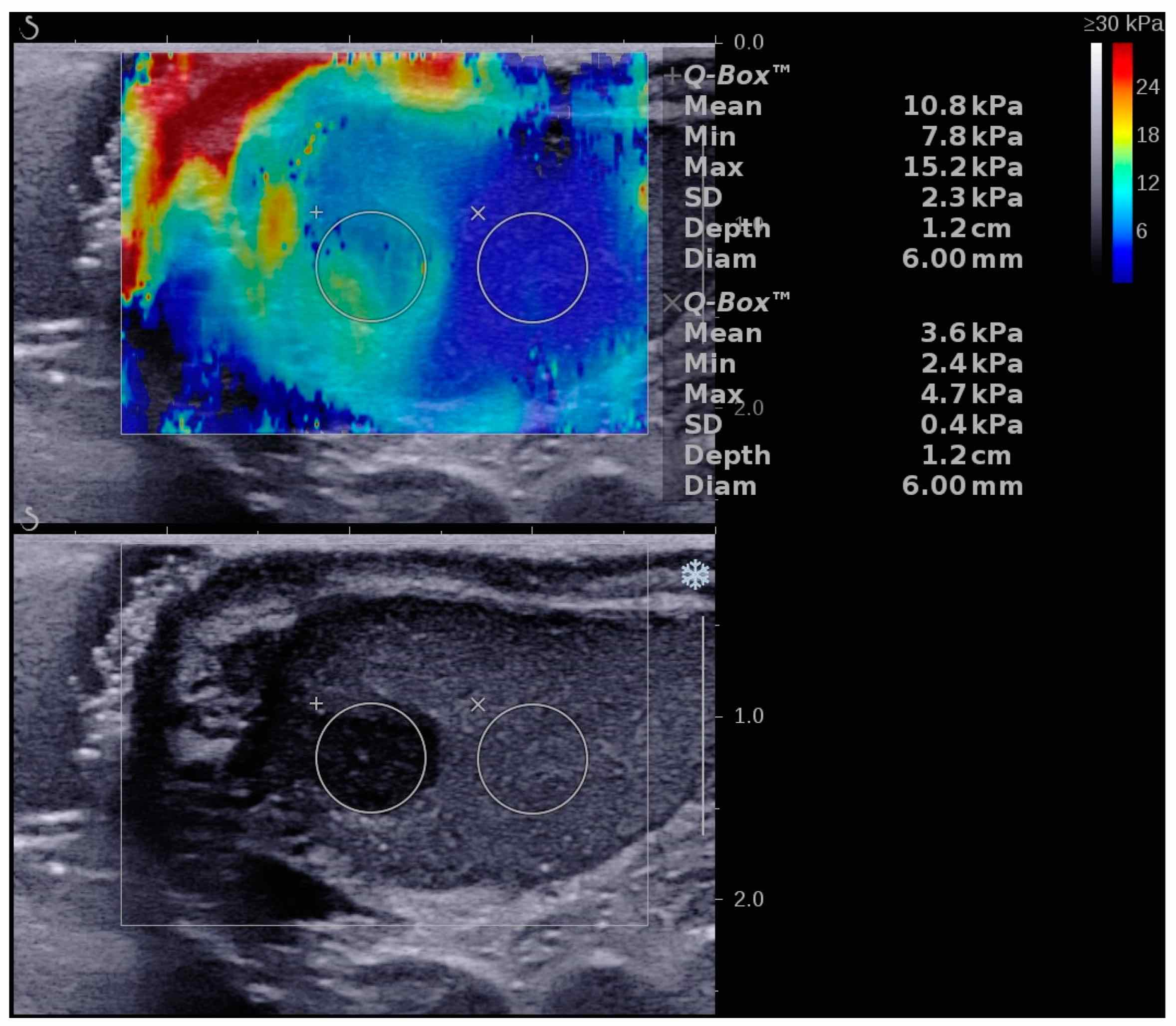 Еластографія